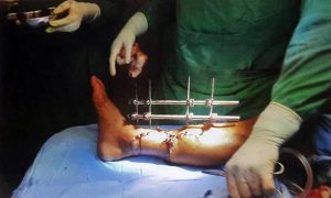 leg-join-in-b-and-c-hospital-ratopati_DSNIJWUpLC